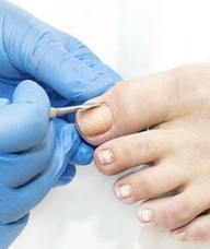 Book an Appointment with Nail Surgery Team for Podiatry